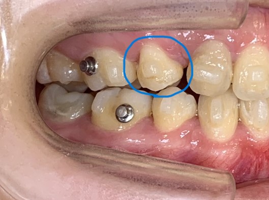 アタッチメント