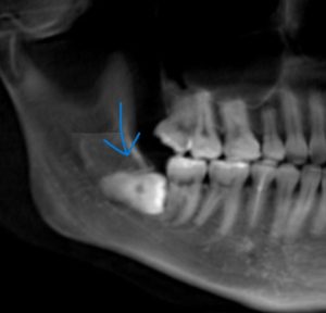 親知らず埋伏歯