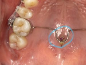 アンカースクリュー