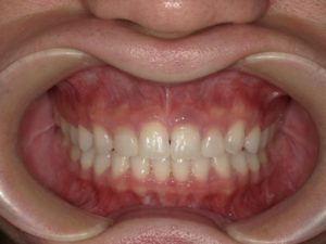 矮小歯アフター