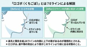 口ゴボとは?Eライン 解説