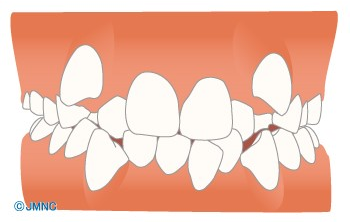 歯のデコボコ